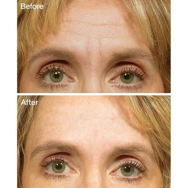 IHerb Health & Beauty FROWNIES Wrinkle Remover Facial Pads Forehead Between Eyes & Mouth 18 Patches 6 IHerb Health & Beauty FROWNIES Wrinkle Remover Facial Pads Forehead Between Eyes & Mouth 18 Patches